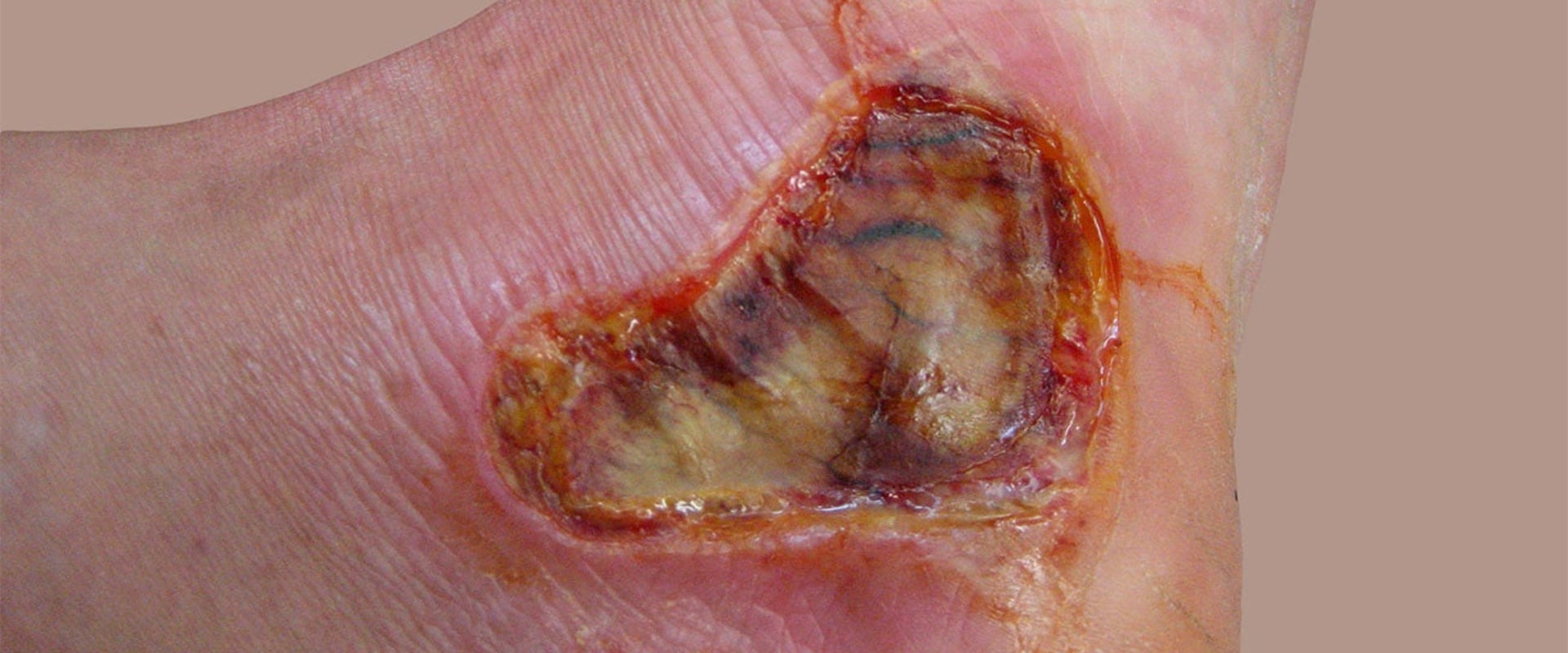 The Different Degrees of Burns: Understanding the Severity and Treatment