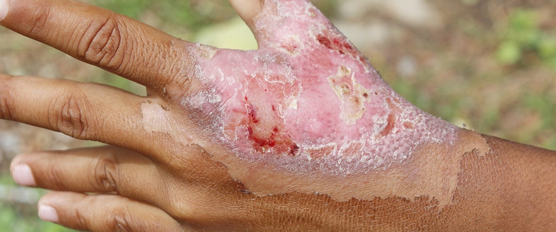 The Power of Natural Remedies for Healing Third Degree Burns