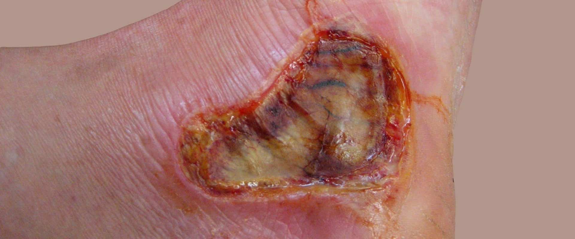 The Healing Process of Third-Degree Burns