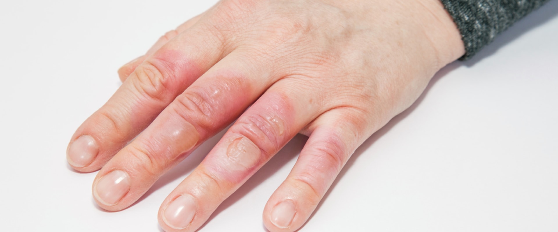 Understanding Second-Degree Burns: Symptoms, Treatment, and Healing Process