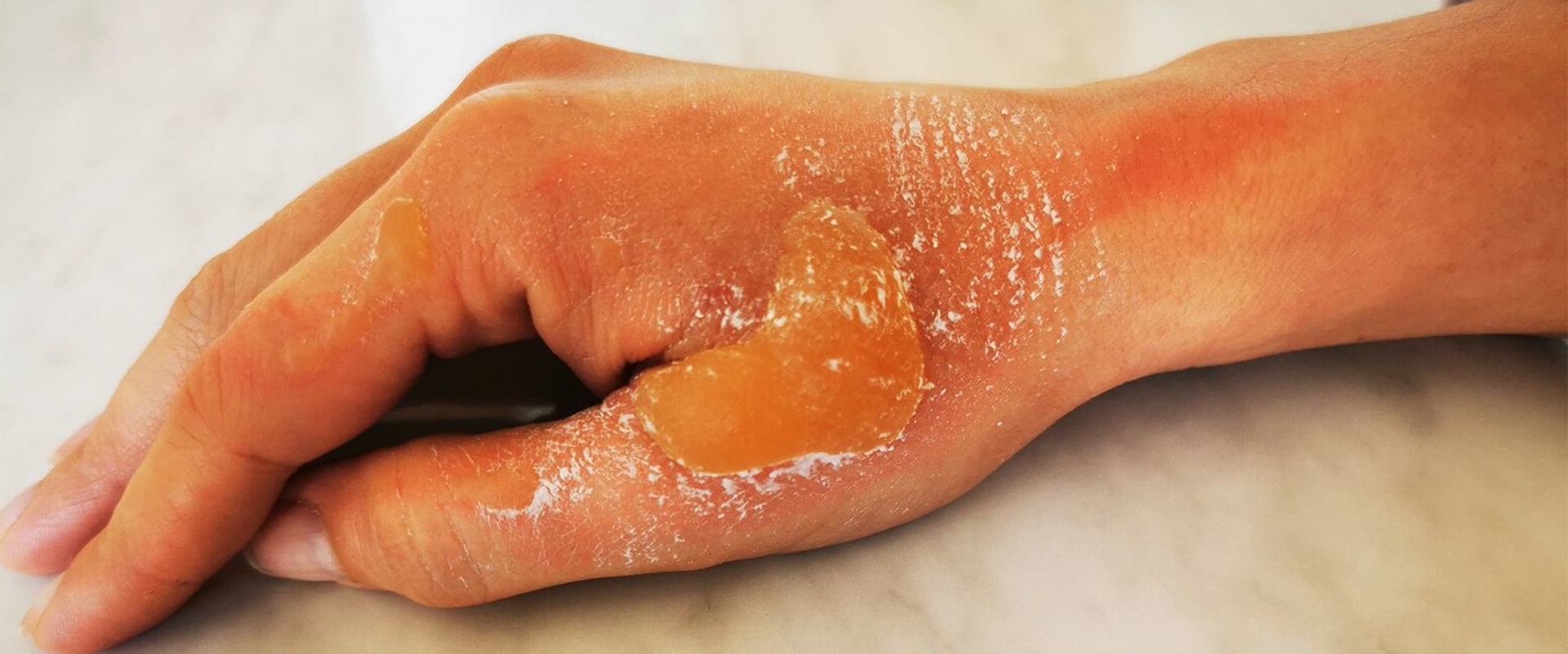 Understanding the Different Degrees of Burns