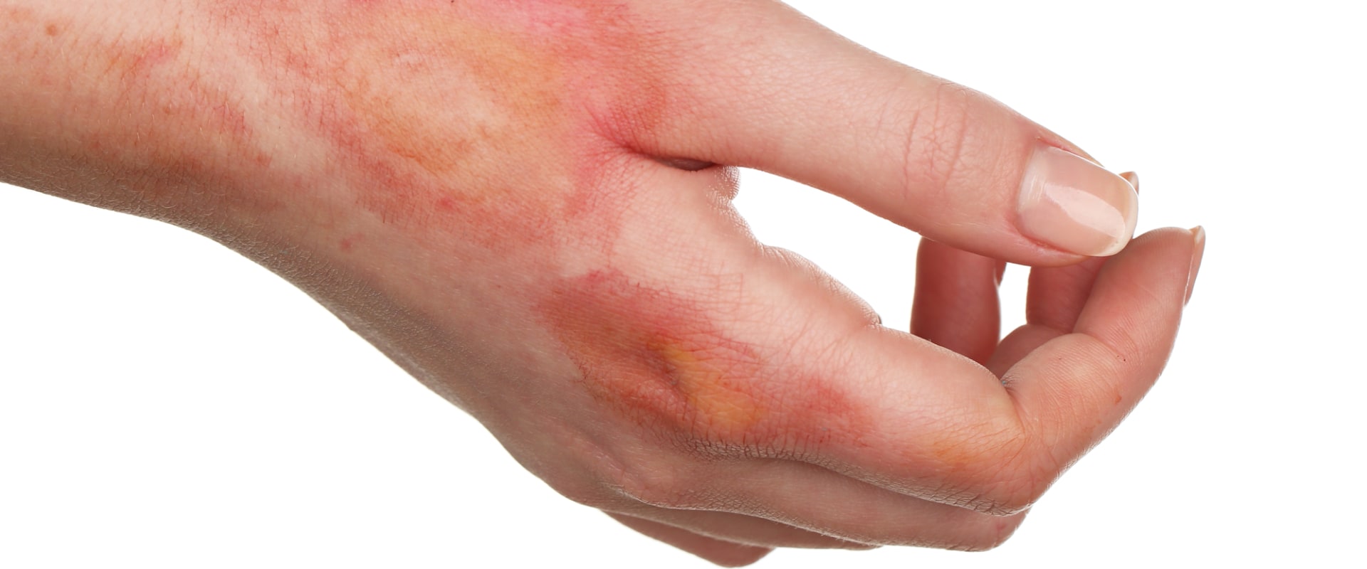 Understanding the Severity of 5th Degree Burns