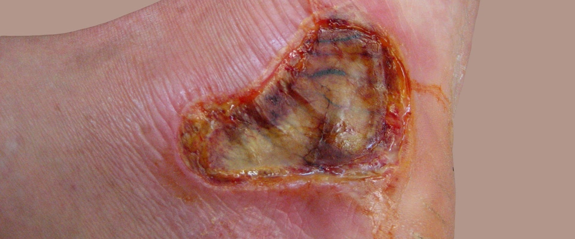 Expert Tips for Treating Severe Burns