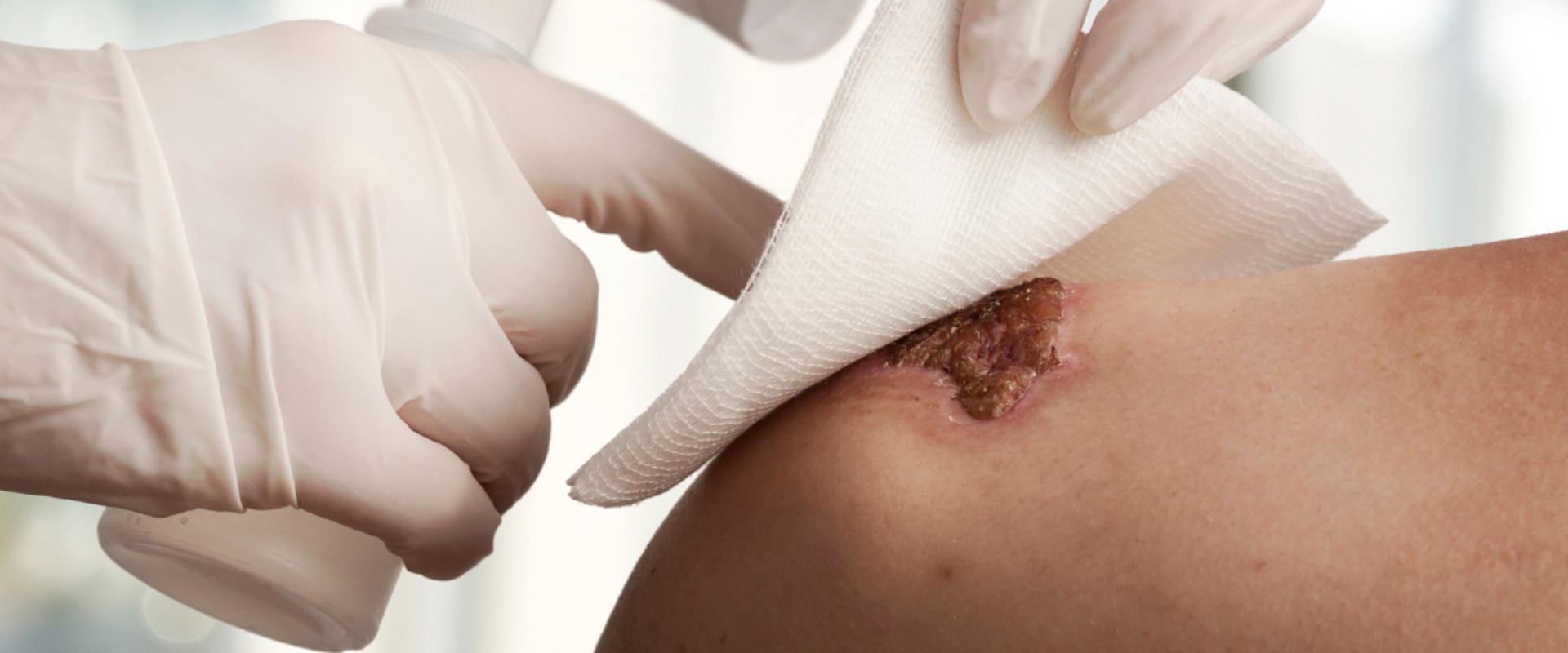 Effective Use of Hydrocolloid Dressing Examples in Third-Degree Burn Wound Care