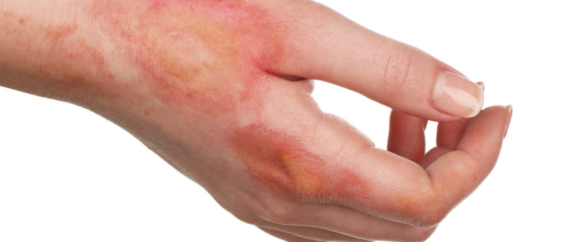 Understanding the Different Degrees of Burns and How to Treat Them