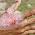 The Power of Natural Remedies for Healing Third Degree Burns