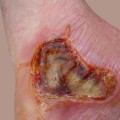 The Complex Healing Process of Third-Degree Burns