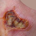 Expert Tips for Treating Severe Burns