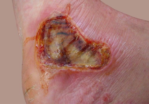 The Different Degrees of Burns: Understanding the Severity and Treatment