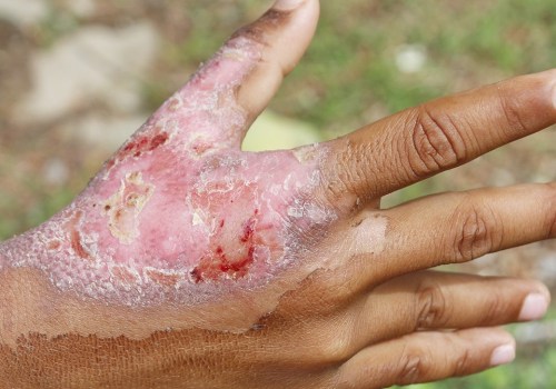 The Importance of Seeking Medical Attention for Third-Degree Burns: An Expert's Perspective