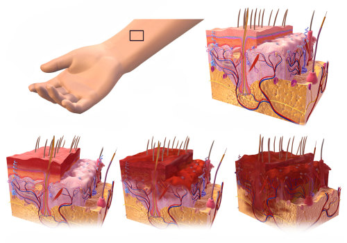 The Importance of Understanding the Different Degrees of Burns