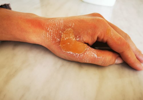 Understanding the Different Degrees of Burns