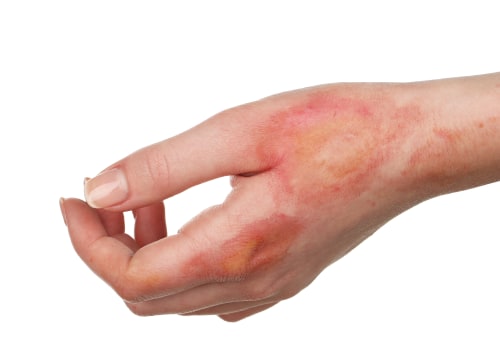 Understanding the Severity of 5th Degree Burns