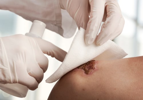 Effective Use of Hydrocolloid Dressing Examples in Third-Degree Burn Wound Care