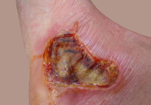 Understanding Third-Degree Burns: What You Need to Know